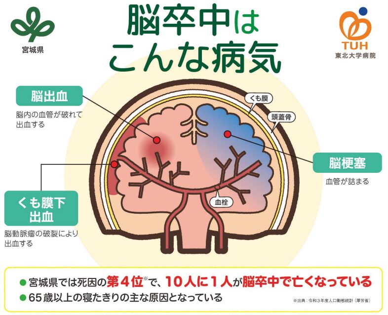 脳卒中の図解