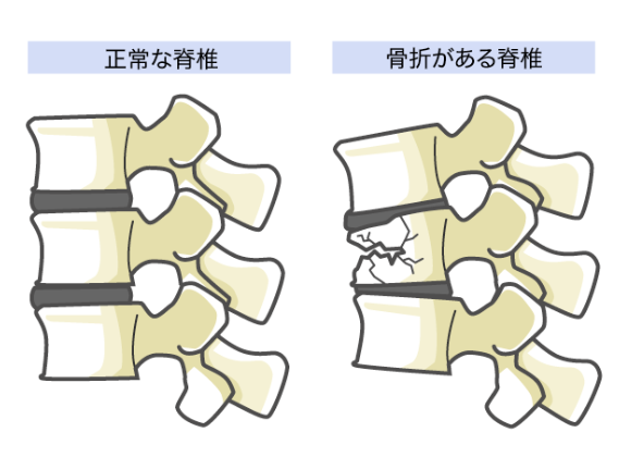 脊椎骨折のイメージ図