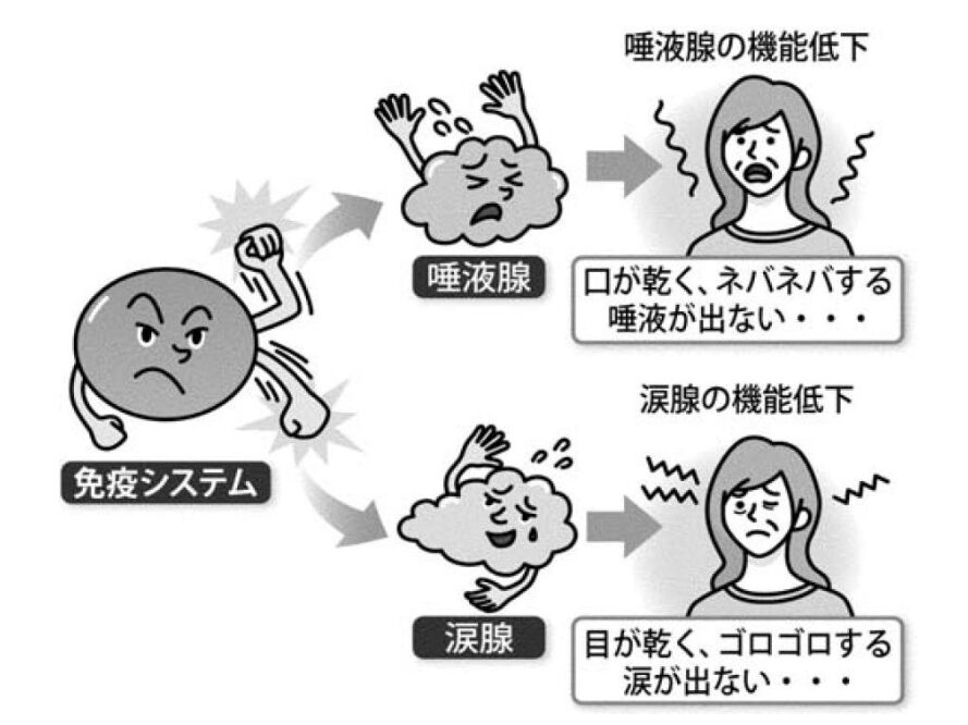 シェーングレン症候群