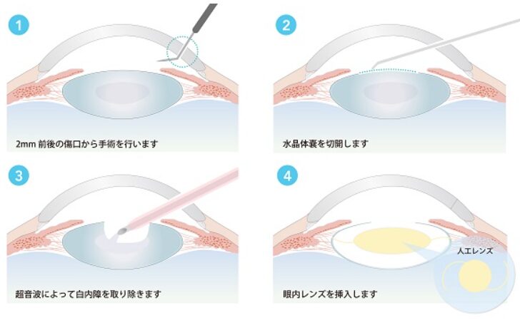 白内障の手術