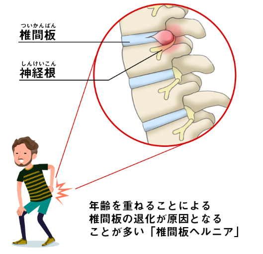 椎間板ヘルニア